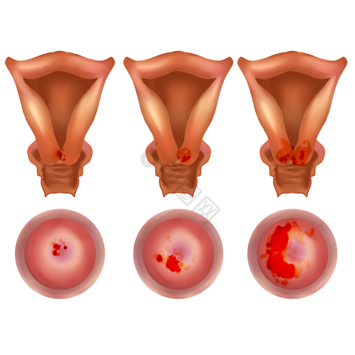 女性健康宫颈癌癌症图片