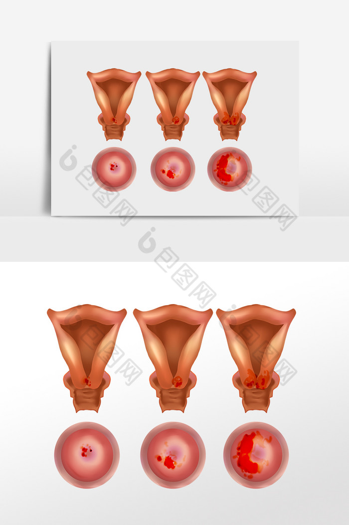 女性健康宫颈癌癌症图片图片