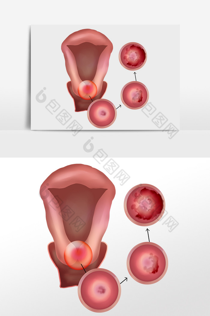 女性健康子宫宫颈癌图片图片