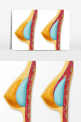 医疗美容假体隆胸示意图