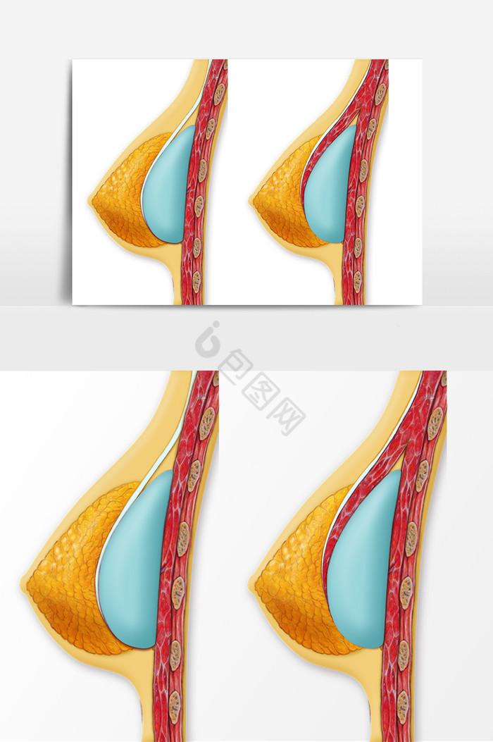 医疗美容假体隆胸示意图图片
