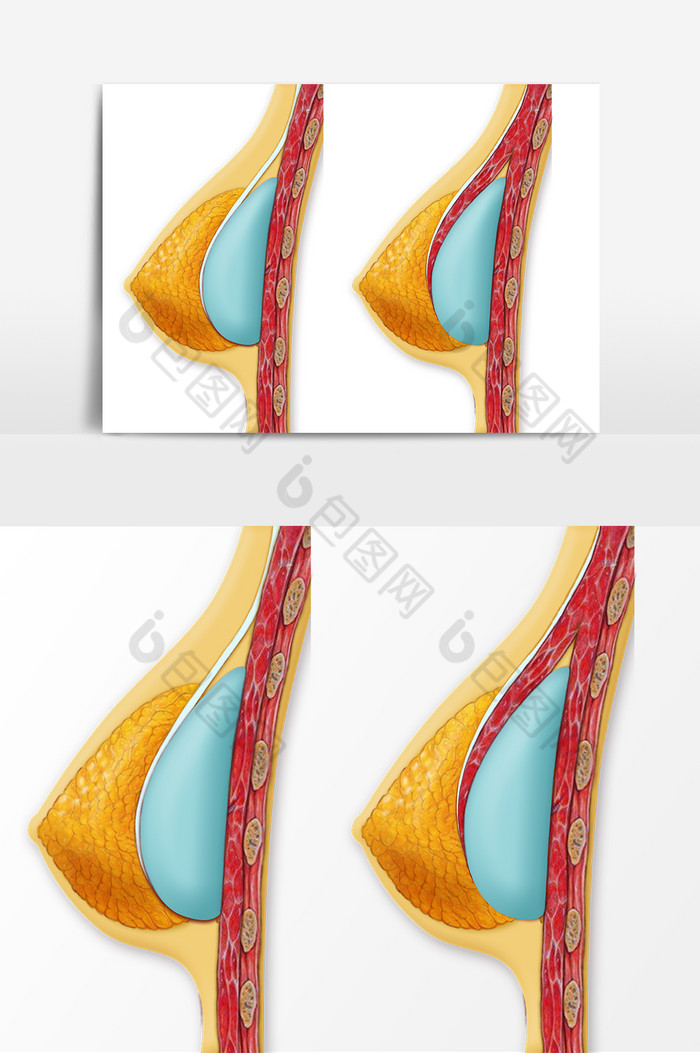 医疗美容假体隆胸示意图图片图片
