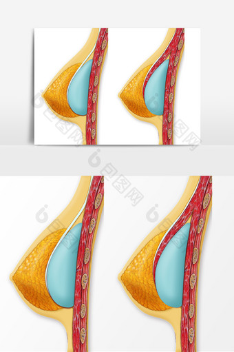医疗美容假体隆胸示意图图片