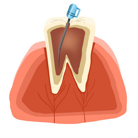 牙科根管治疗牙齿矫正