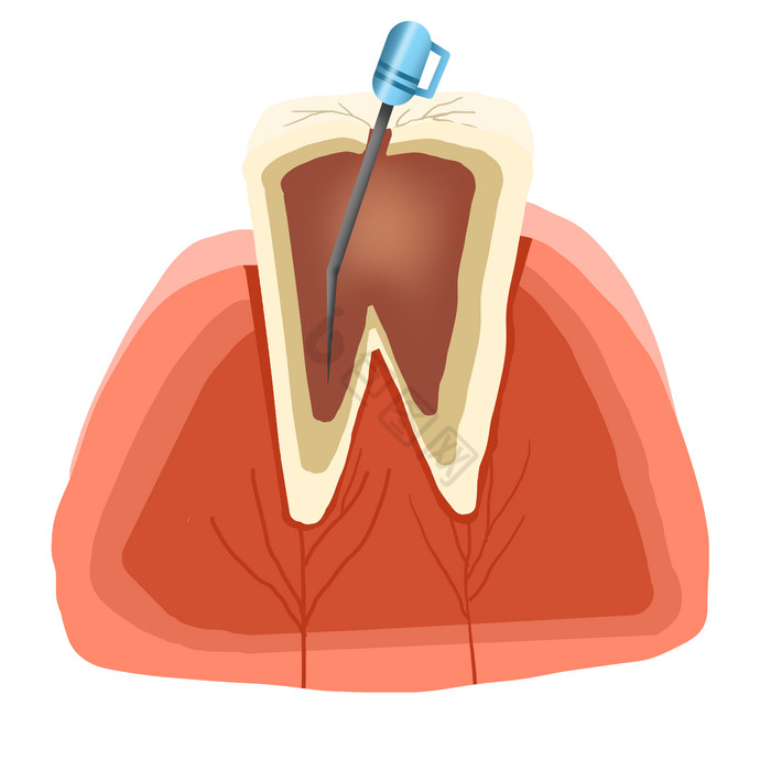 牙科根管治疗牙齿矫正图片