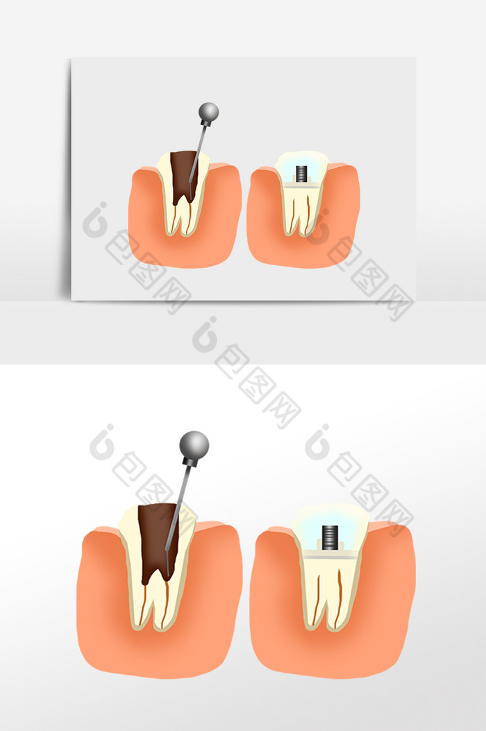 牙科根管治疗牙齿矫正图片图片