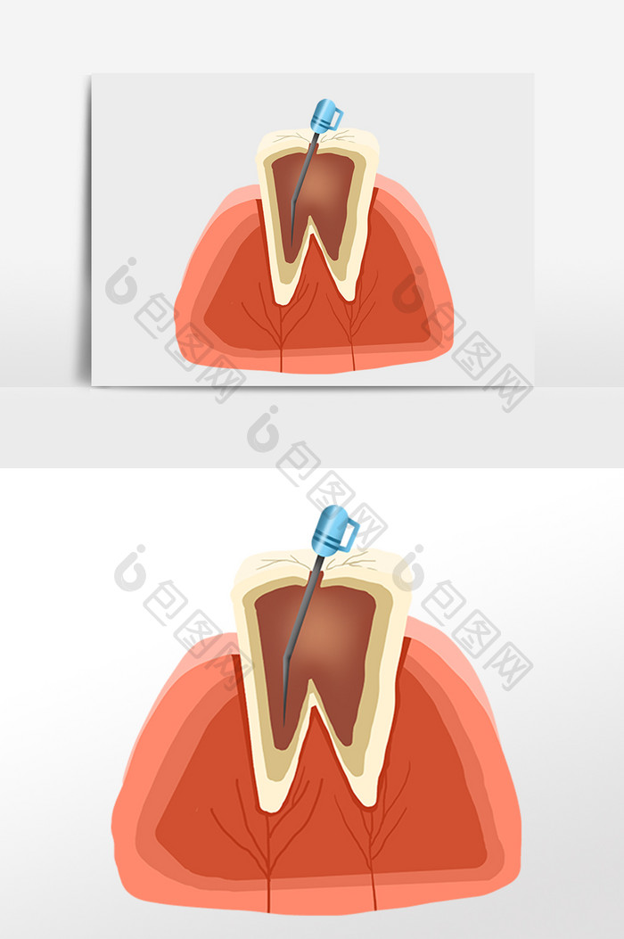 根管治疗牙科牙齿