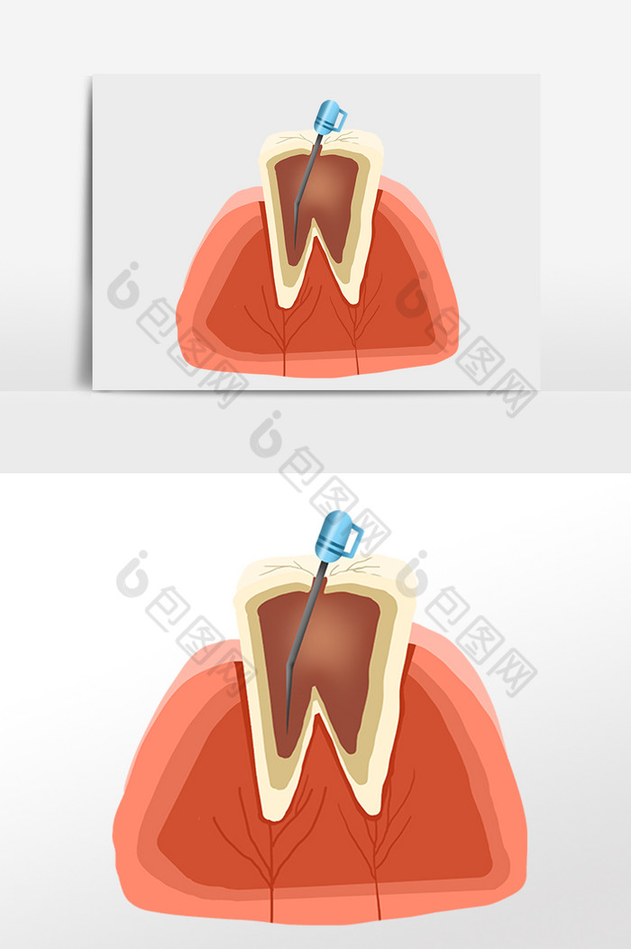 根管治疗牙科牙齿图片图片