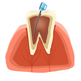 根管治疗牙科牙齿
