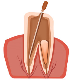 根管治疗牙齿矫正