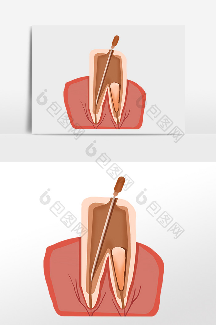 根管治疗牙齿矫正