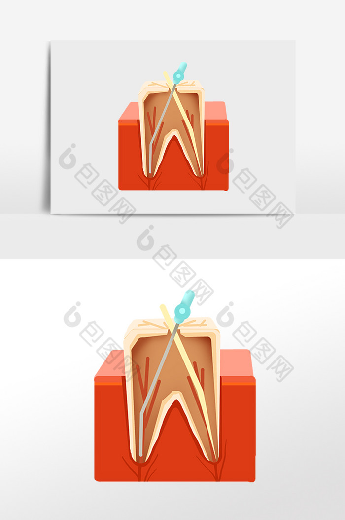 牙科牙齿根管治疗图片图片
