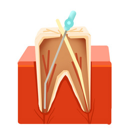 牙科牙齿根管治疗