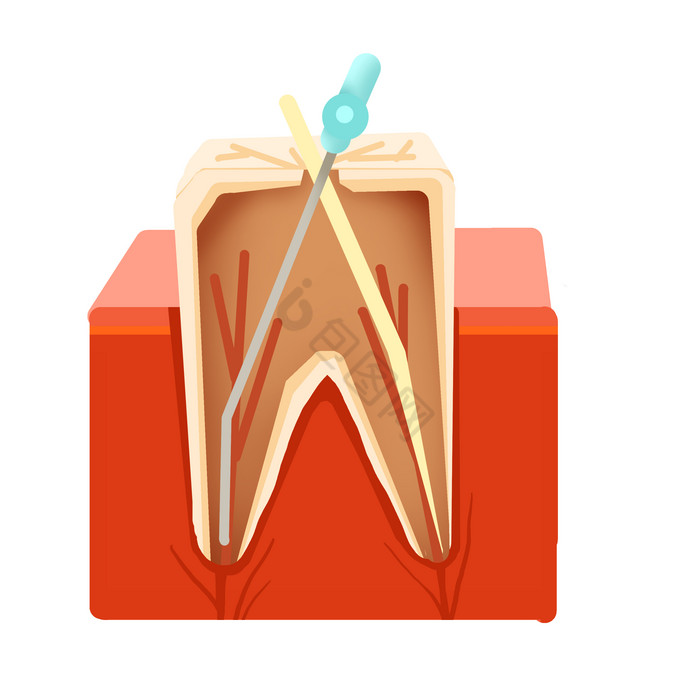 牙科牙齿根管治疗图片