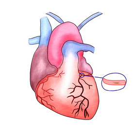 人体内脏心梗疾病