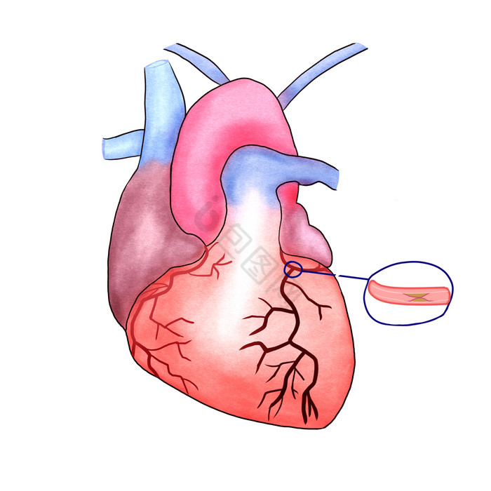 人体内脏心梗疾病图片