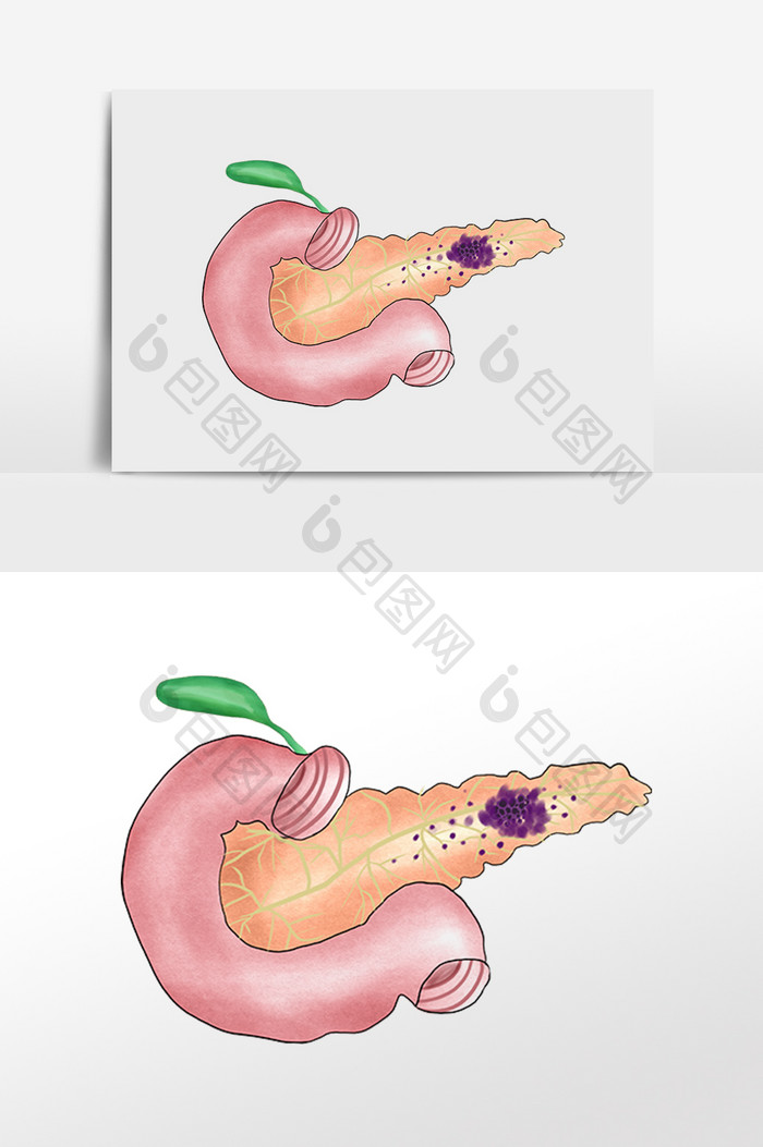 喉咙胰腺炎胰腺癌