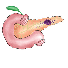 喉咙胰腺炎胰腺癌