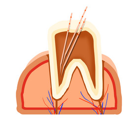 牙科医院根管治疗