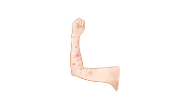易用写实类mg动画受伤部分类手臂上的湿疹
