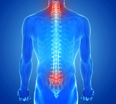 X 射线视图的脊柱疼痛-脊椎创伤