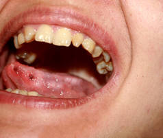 安皮口炎。舌头的念珠菌病。舌头上的溃疡。念珠菌.