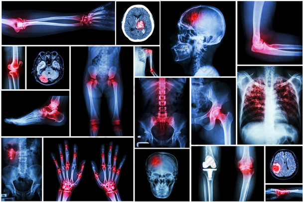 集合 x 射线多疾病 (关节炎、 中风、 脑肿瘤、 痛风、 类风湿、 肾结石、 肺结核、 骨性关节炎膝关节等)