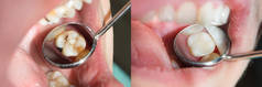人的牙齿特写在恢复填充。美容牙科的概念