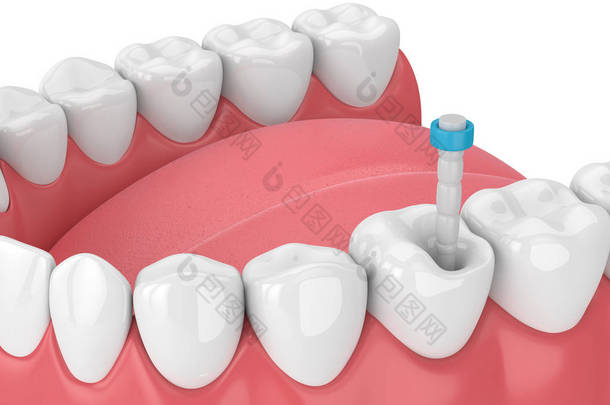 3d 渲染下巴与牙齿和纤维岗位在白色。牙髓治疗概念