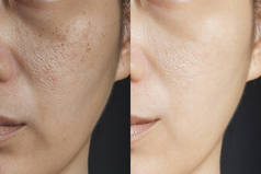 两张图片比较治疗前后的疗效。治疗前后有雀斑、毛孔、皮肤迟钝及皱纹问题的皮肤，以解决皮肤问题，取得更佳效果