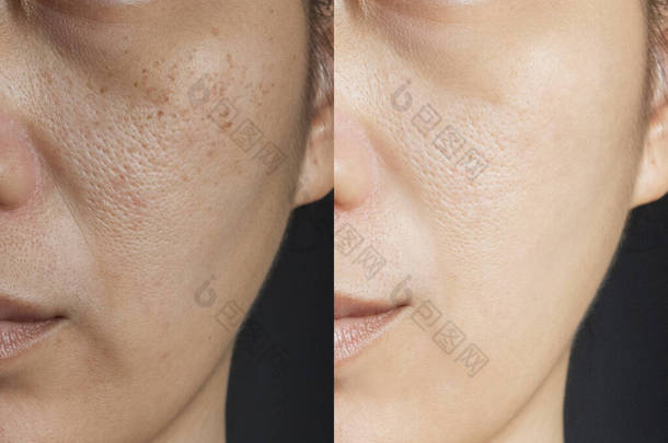两张图片比较治疗前后的疗效。治疗前后有雀斑、毛孔、皮肤迟钝及皱纹问题的皮肤，以解决皮肤问题，取得更佳效果