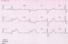 与心肌梗死急性期心电图磁带