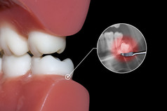 牙科牙痛、 智齿和摩尔的影响