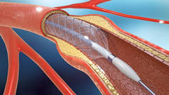 3d. 支架植入术在血管内支持血液循环的例证