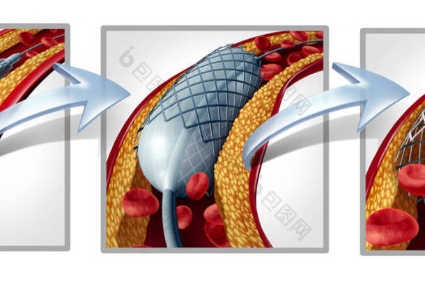 冠状动脉支架和血管成形术的概念作为心脏病治疗符号图与植入程序的阶段在动脉中, 有胆固醇斑块堵塞<strong>被打</strong>开, 以增加血液流量为3d 例证.