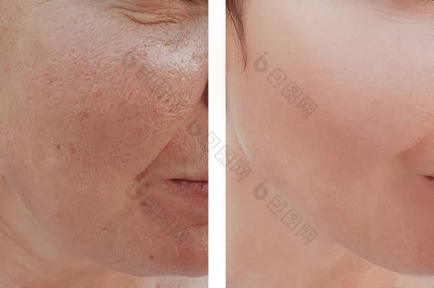 妇女皱纹面孔在规程之前和之后