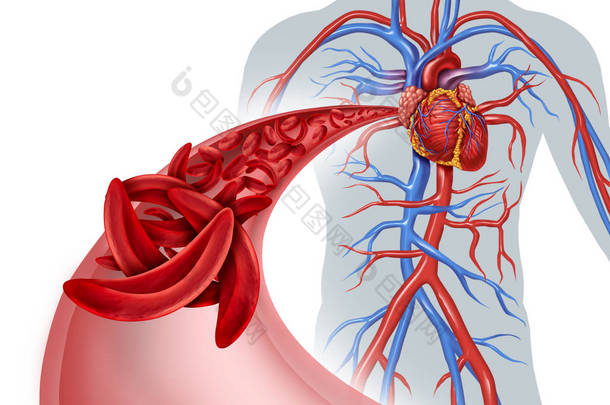 镰状细胞心脏循环阻塞和贫血作为一种疾病与正常和异常血红蛋白在人的动脉解剖学与心脏心血管医学例证概念与3d 例证元素.