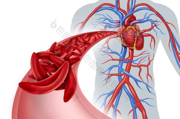 镰状细胞<strong>心</strong>脏循环阻<strong>塞</strong>和贫血作为一种疾病与正常和异常血红蛋白在人的动脉解剖学与<strong>心</strong>脏<strong>心</strong>血管医学例证概念与3d 例证元素.