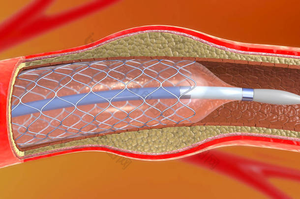 3d. 支架植入术在血管内支持<strong>血液循环</strong>的例证