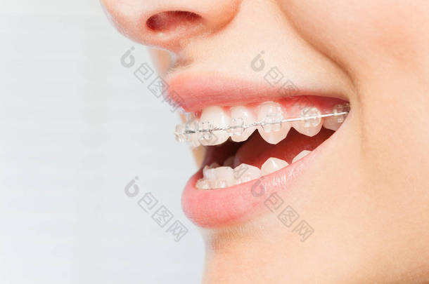 侧面视图图片女人的微笑与牙科大括号白色