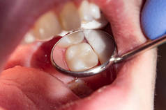 在牙科诊所的治疗阶段, 一个人腐烂的龋齿牙齿的特写。橡胶坝系统与乳胶围巾和金属夹的使用, photopolymeric 复合填料的生产