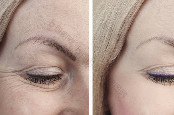 手术前后女性眼睛皱纹