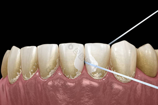 口腔卫生：使用牙线去除牙菌。医学上准确的牙科 3D 插图