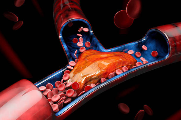 3d <strong>深静脉血栓</strong>形成或血块的插图。栓塞