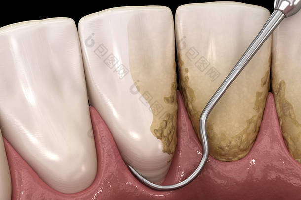 口腔卫生：烫伤和根部修整（常规牙周病治疗） 。医学上准确的人类牙齿治疗三维图像