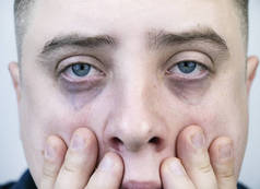 眼皮底下的包，男人脸上的疱疹。眼睑成形术前整形外科医生检查病人