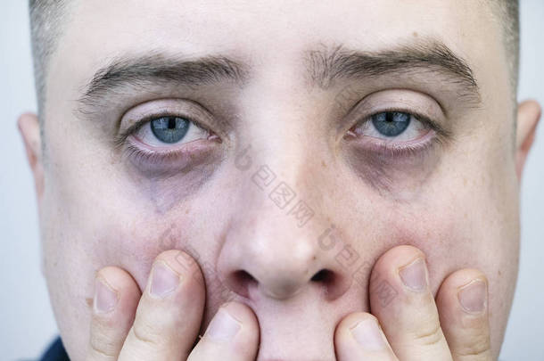 眼皮<strong>底下</strong>的包，男人脸上的疱疹。眼睑成形术前整形外科医生检查病人
