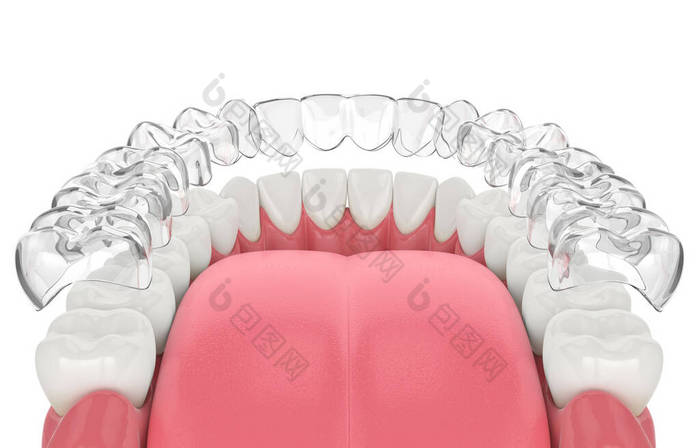 下颌骨在白色背景上的渐变可移隐形固位体三维绘制