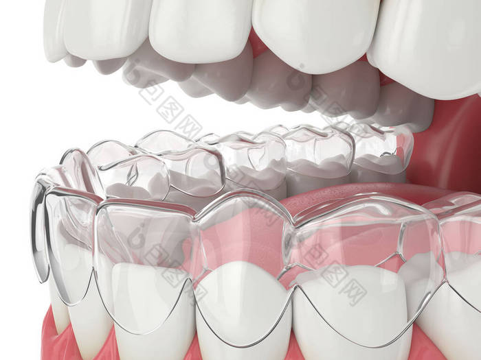 白色背景上带渐变可摘可摘固位颌骨3D渲染