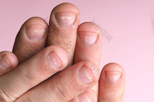 男性指甲上的白斑是由缺乏钙、锌或家庭化学品在粉色背景下造成的。这种病叫做白血病.